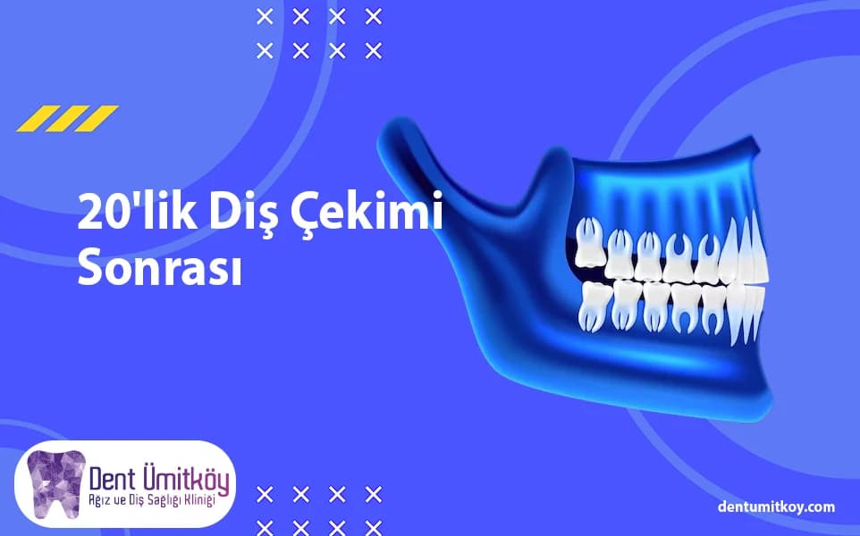 After Wisdom Tooth Extraction: A Detailed Guide to the Entire Process