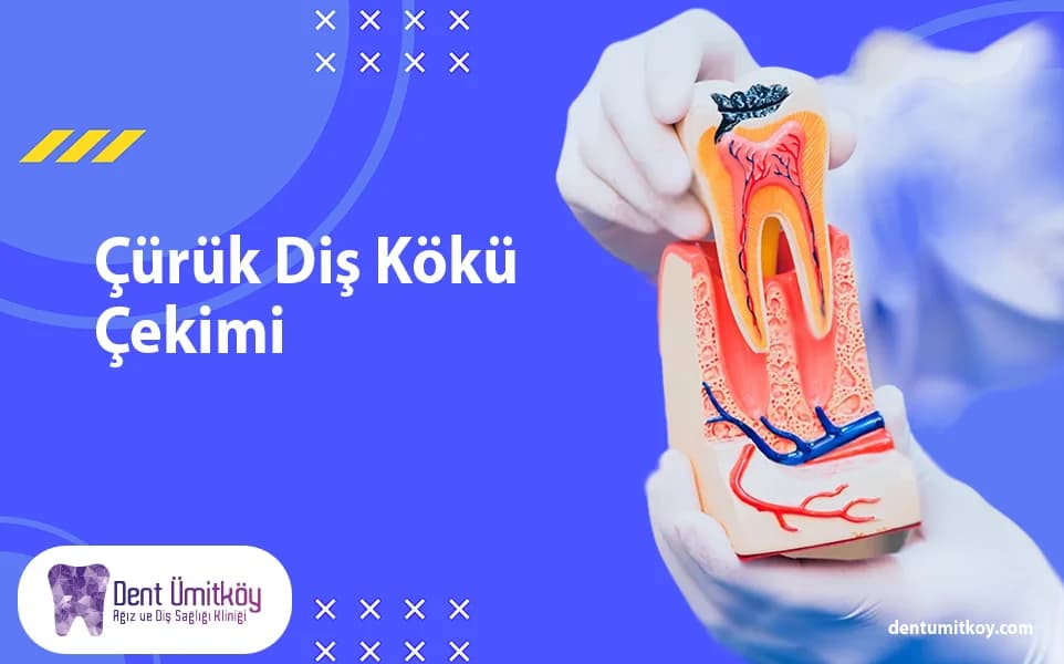 Extraction of a Decayed Tooth Root