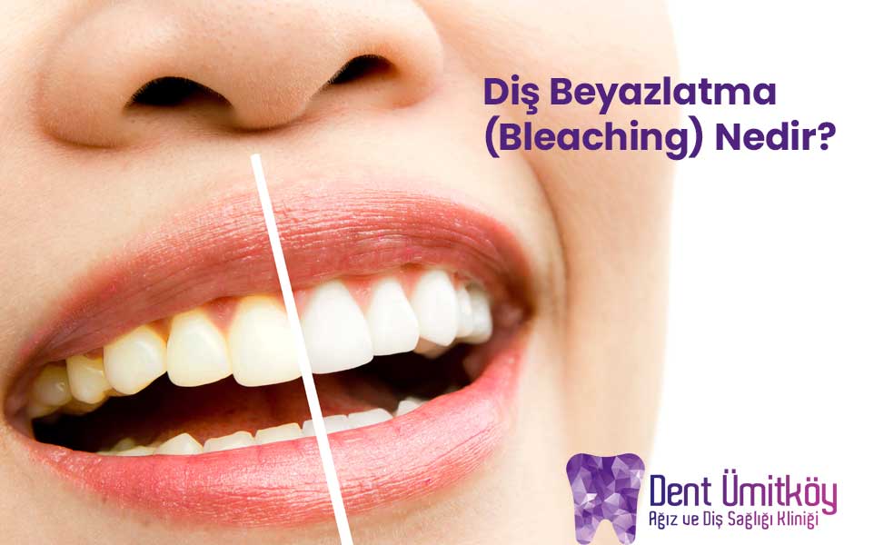 What Is Teeth Whitening (Bleaching)?