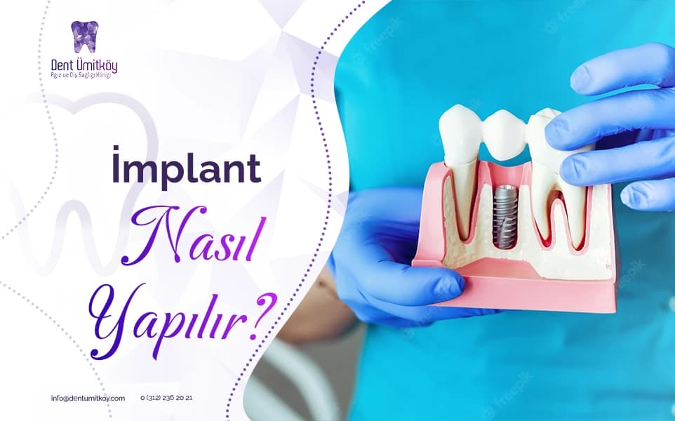 İmplant Nasıl Yapılır?
