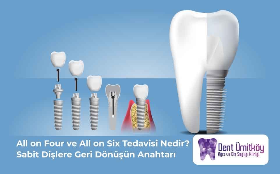 All on Four ve All on Six Tedavisi Nedir?