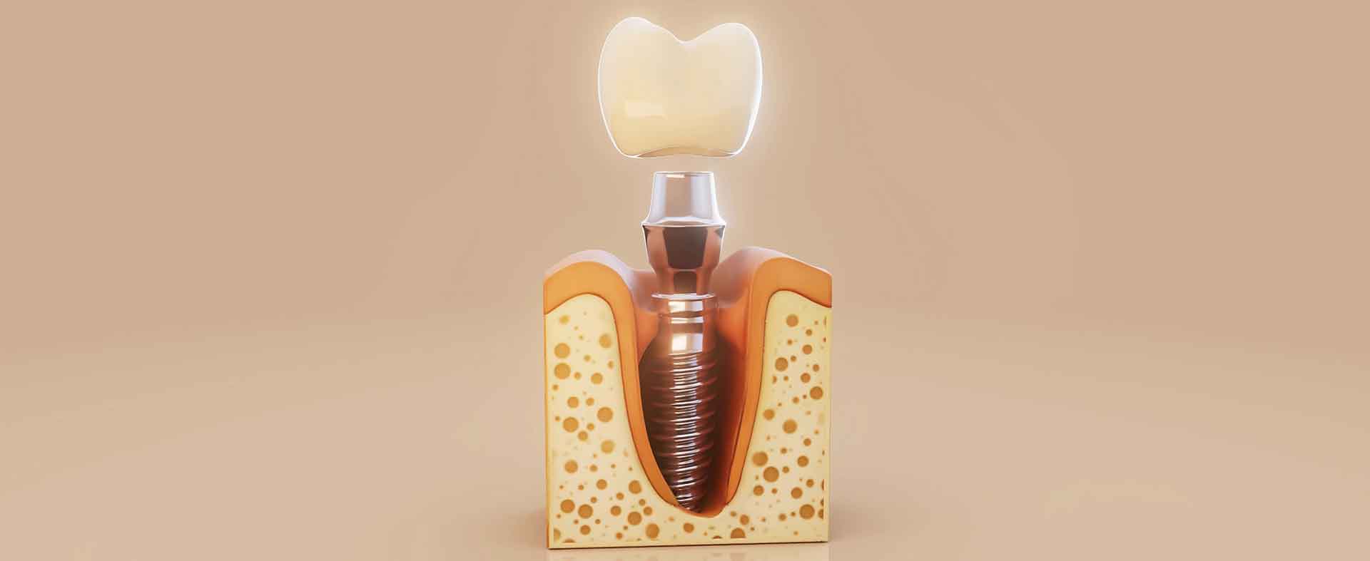 Bir günde implant ankara-2