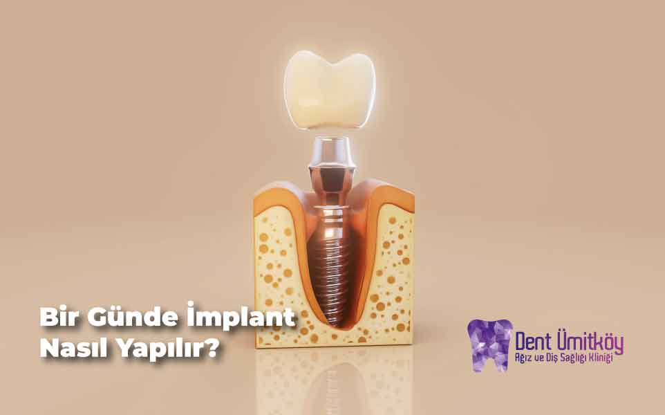 Bir Günde İmplant Ankara