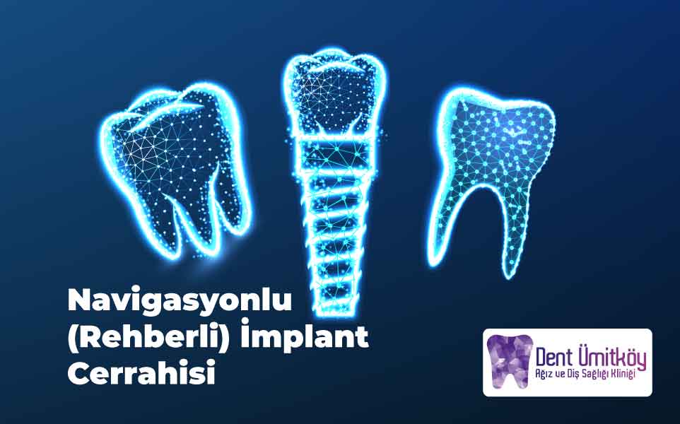 Navigasyonlu Rehberli İmplant Cerrahisi