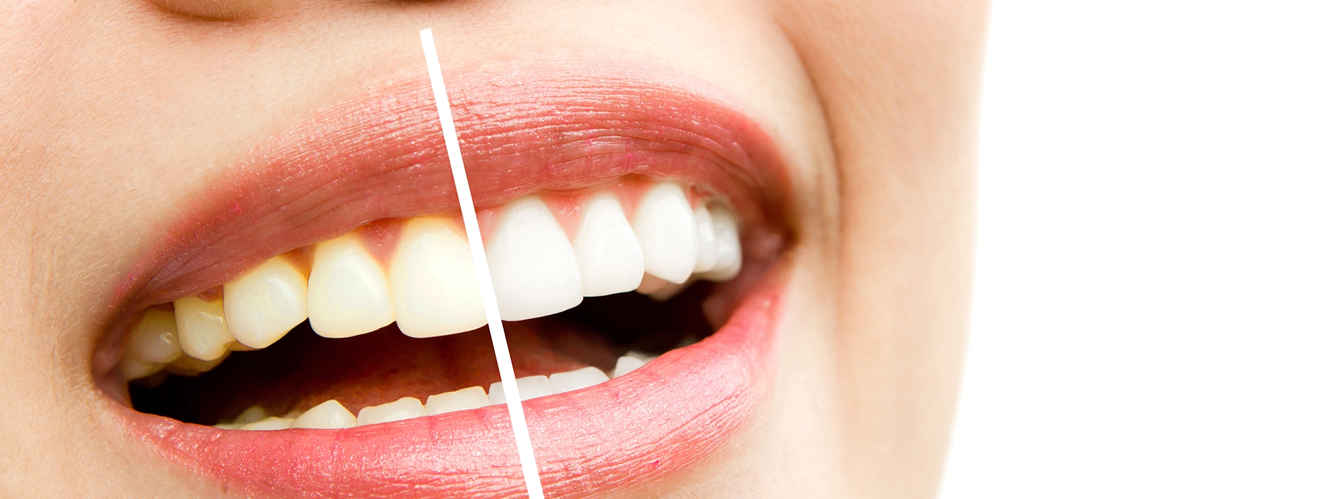 Diş Beyazlatma (Bleaching) Nedir?