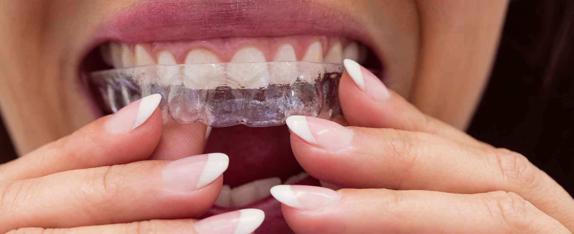 Invisalign (Şeffaf Plak) Tedavisi Fiyatları