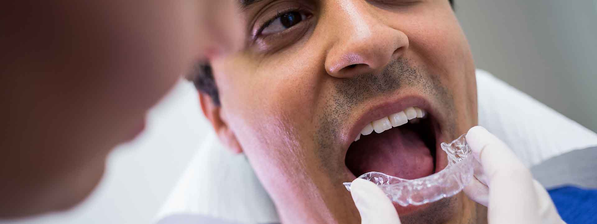 Şeffaf Plak (Invisalign) Fiyatları