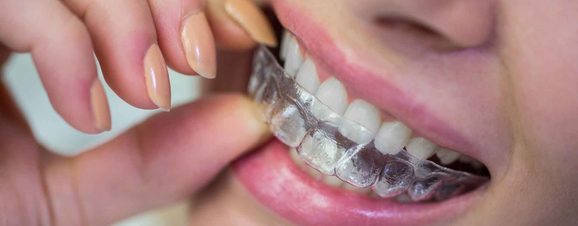Şeffaf Plak (Invisalign)Tedavisi Nedir?