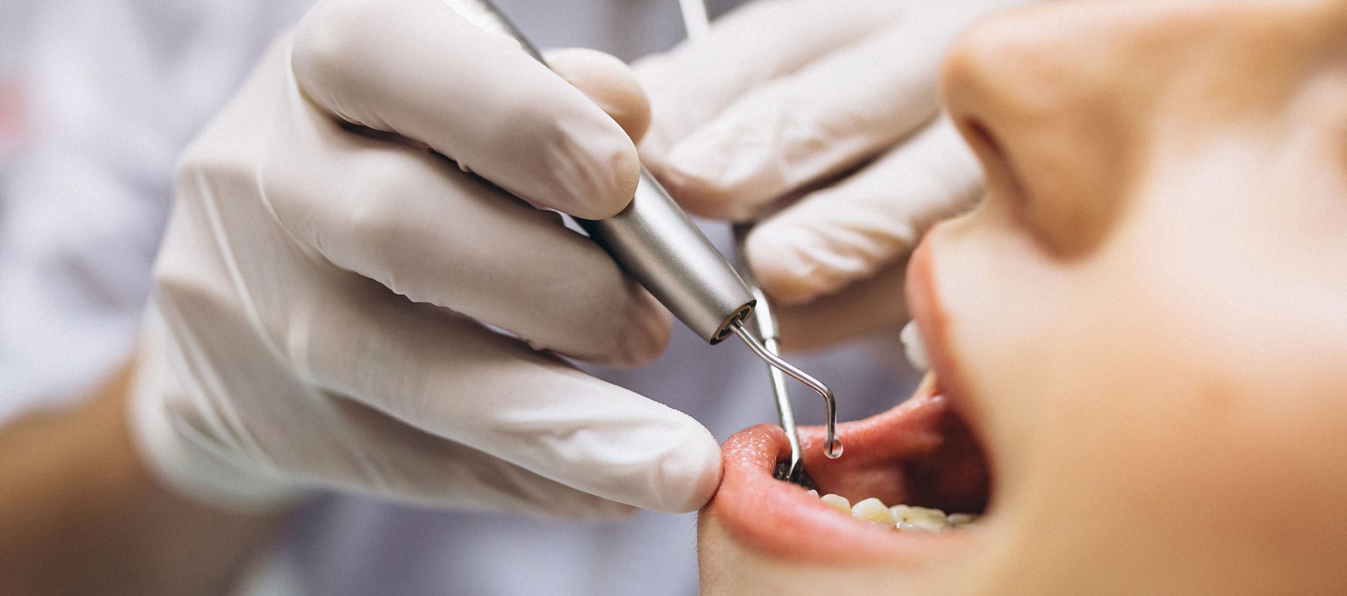Ankara Endodonti Tedavisi
