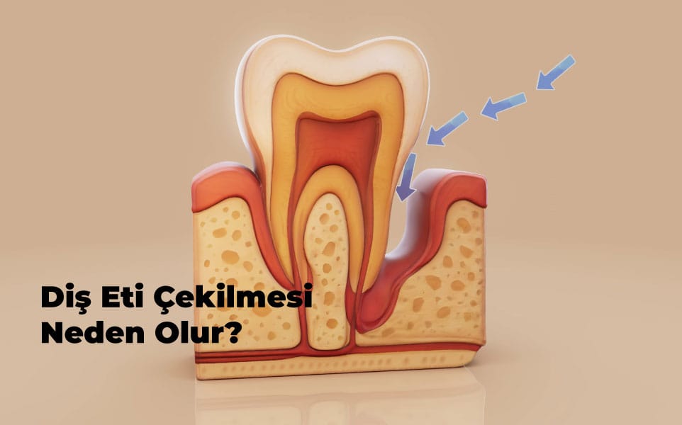 Diş Eti Çekilmesi Neden Olur?